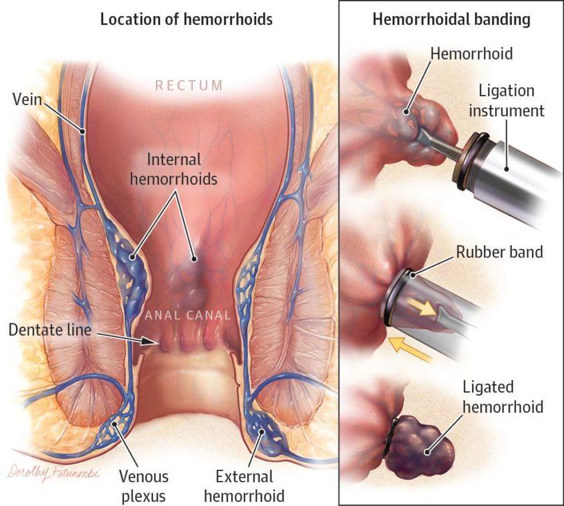 Hemorrhoid Banding: What You Need to Know 
