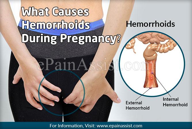 What to Know About Pregnancy Hemorrhoids 