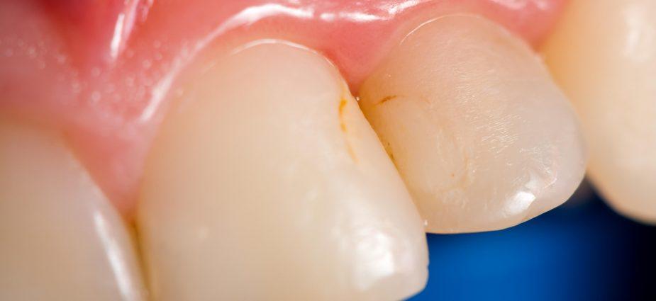 What’s the Cause of That Dark Spot on Your Tooth? 