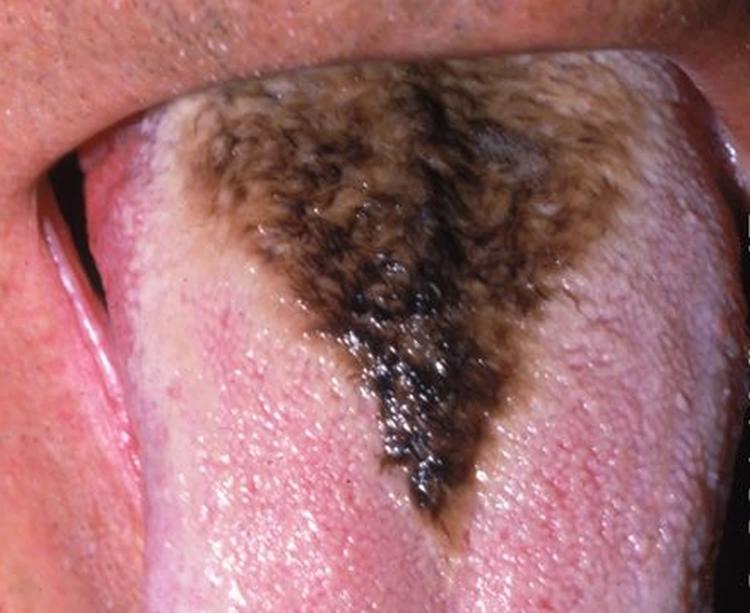 What Is Black Tongue?
