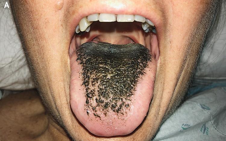 What Is Black Tongue? 