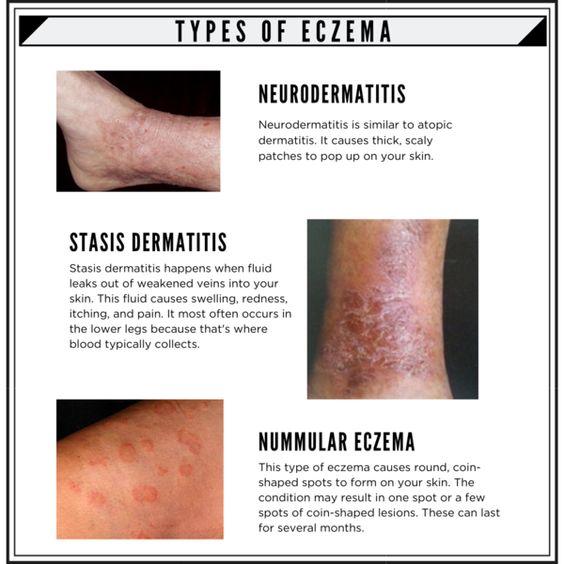 What Are the 7 Different Types of Eczema?