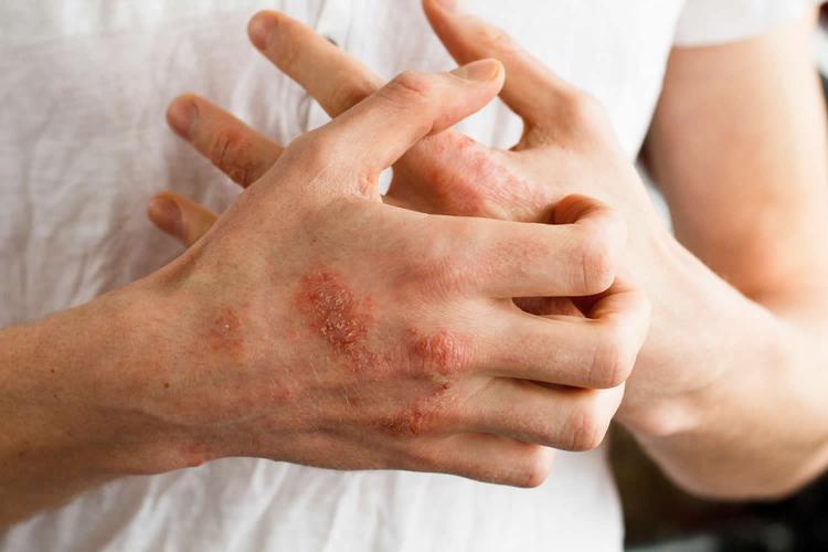 What to Know About Latex Allergies 