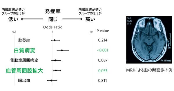  花王、65歳以上の人における内臓脂肪と認知症の関係性を発見　弘前大学グループと共同研究