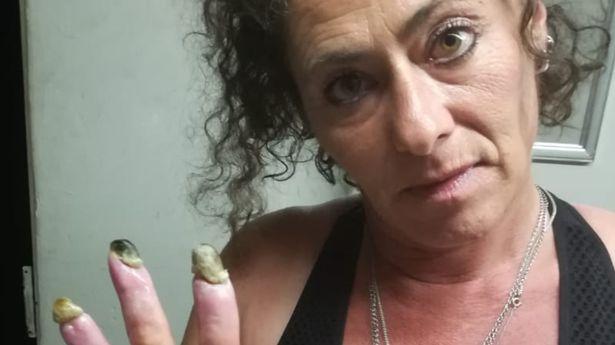 Woman's fingers turn black and are close to falling off after years of smoking