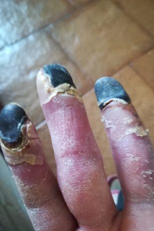 Woman's fingers turn black and are close to falling off after years of smoking 