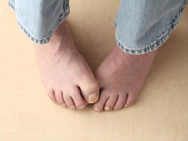 6 home remedies to treat toenail infection