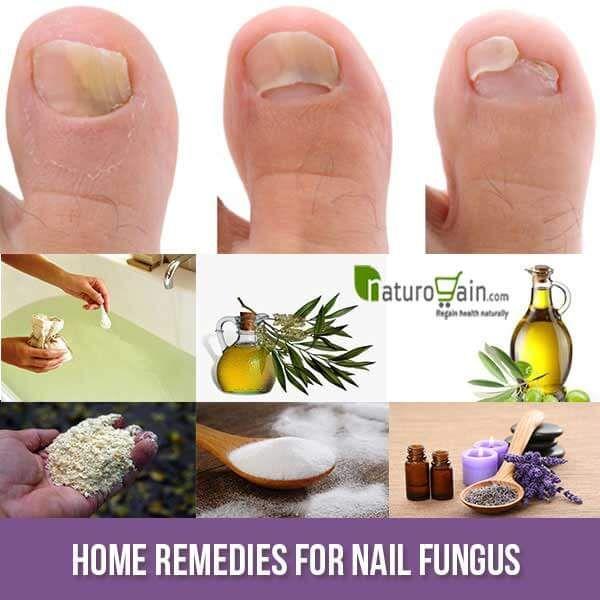 6 home remedies to treat toenail infection 
