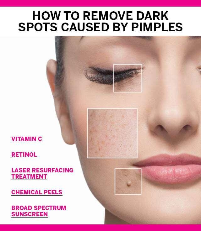 How to Remove Dark Spots from Pimples