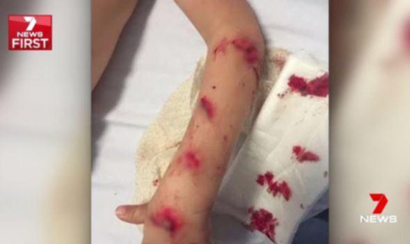 Perth boy Cruz Varrone shows scars after shocking shower screen explosion