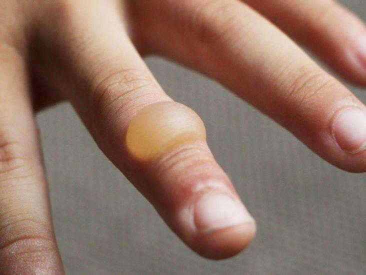 Everything you need to know about treating a burned finger