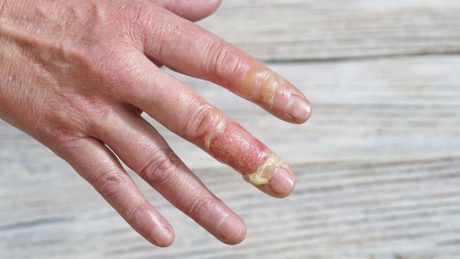 Everything you need to know about treating a burned finger 