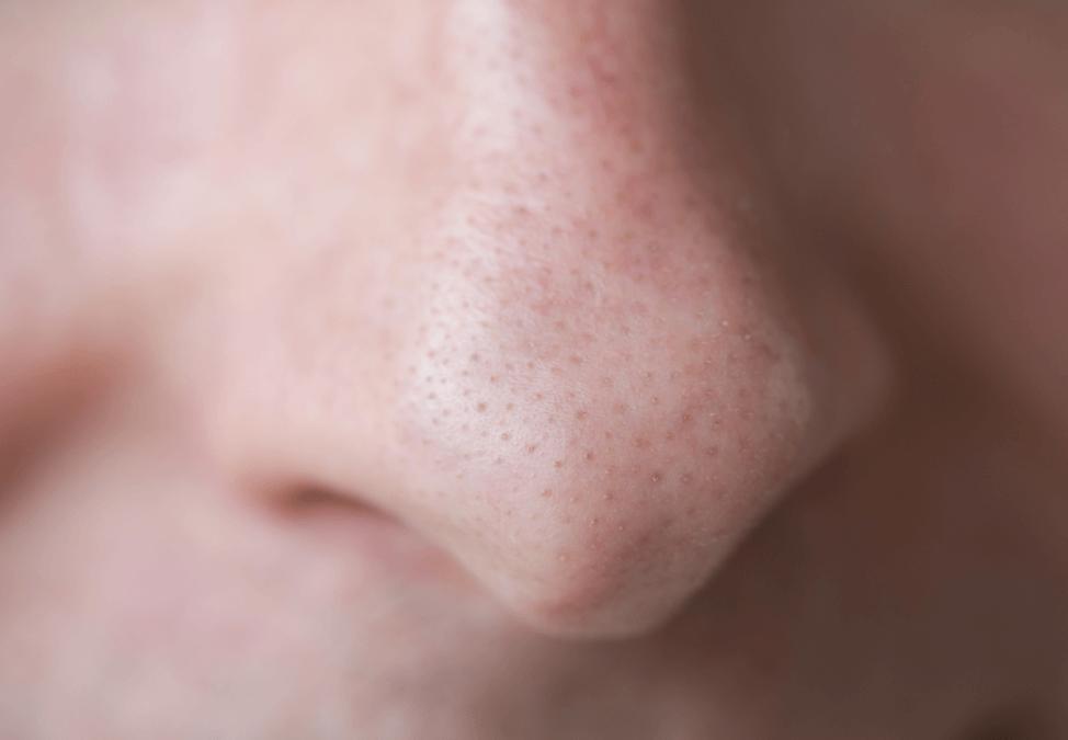 The blackheads on your nose are actually a form of acne. Here's how to get rid of them for good. 