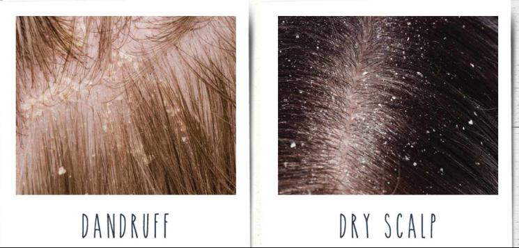 What causes a dry scalp, and how can you treat it?