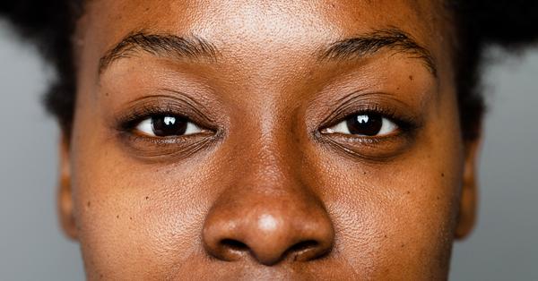 Eczema Looks Different on Melanated Skin; Here's How to Treat It 