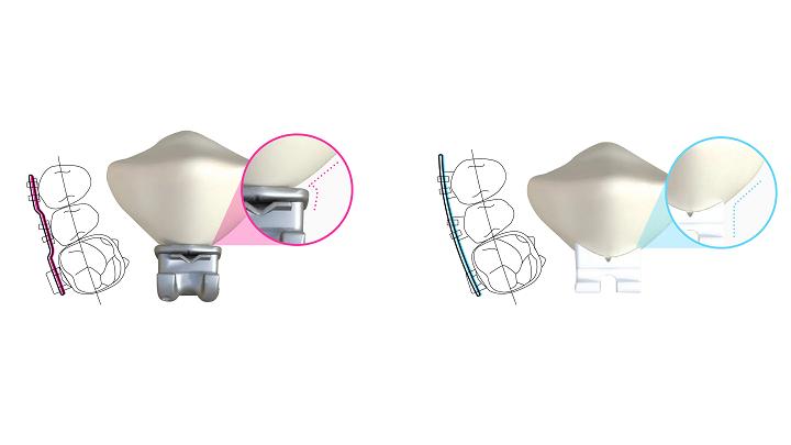 LightForce Orthodontics Raises $14M for Custom 3D Printed Braces