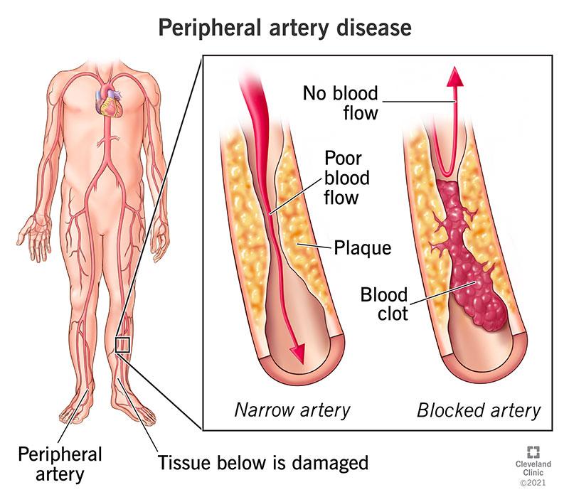 Cardiologists’ Top Tips for Peripheral Arterial Disease 