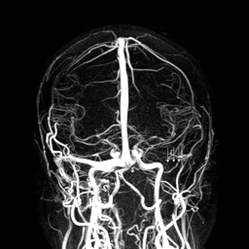 Neuro-ophthalmic complications of vestibular schwannoma | EB 