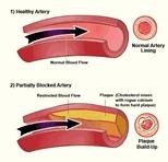 Can Diabetes Cause High Blood Pressure? 