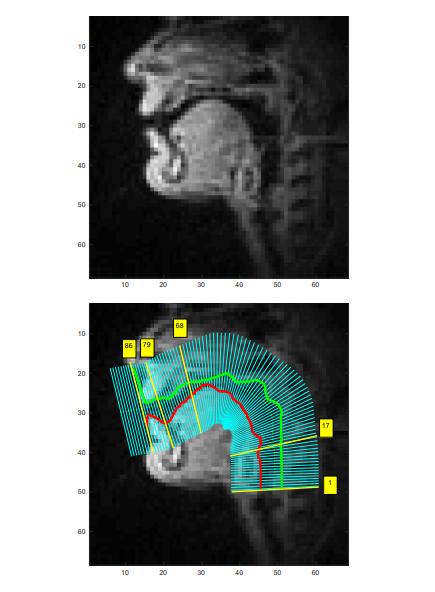 のどの動きをMRIで解析し、口パクをテキストに変換　言語障がい者などのコンピュータ利用の一助に
