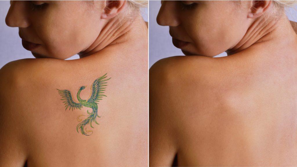 Comment enlever un tatouage ? Découvrez les différentes méthodes accompagnées de nombreux conseils !