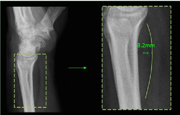A pediatric wrist trauma X-ray dataset (GRAZPEDWRI-DX) for machine learning 